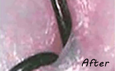 毛根断面図 after photo